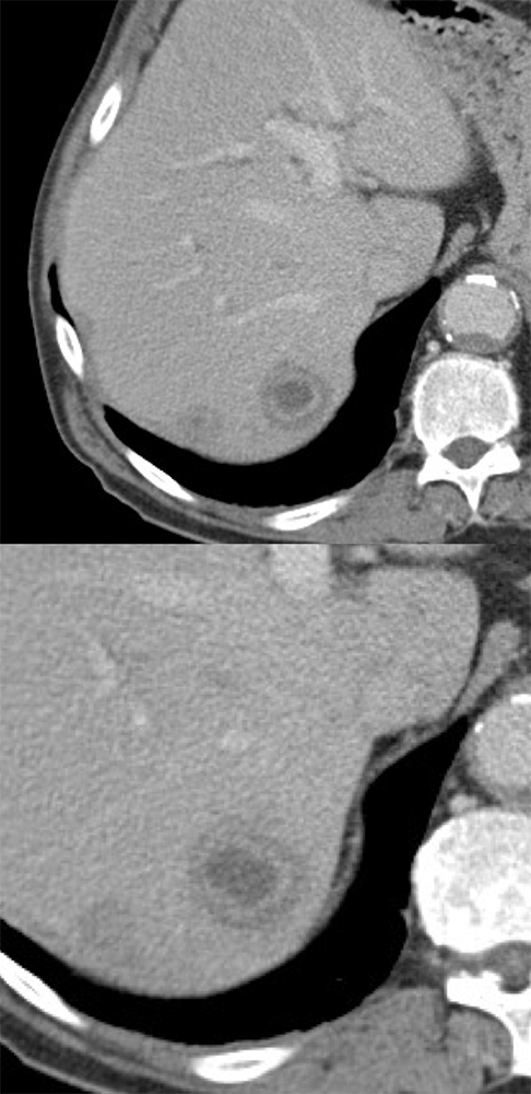 Post-Operative Liver Abscess