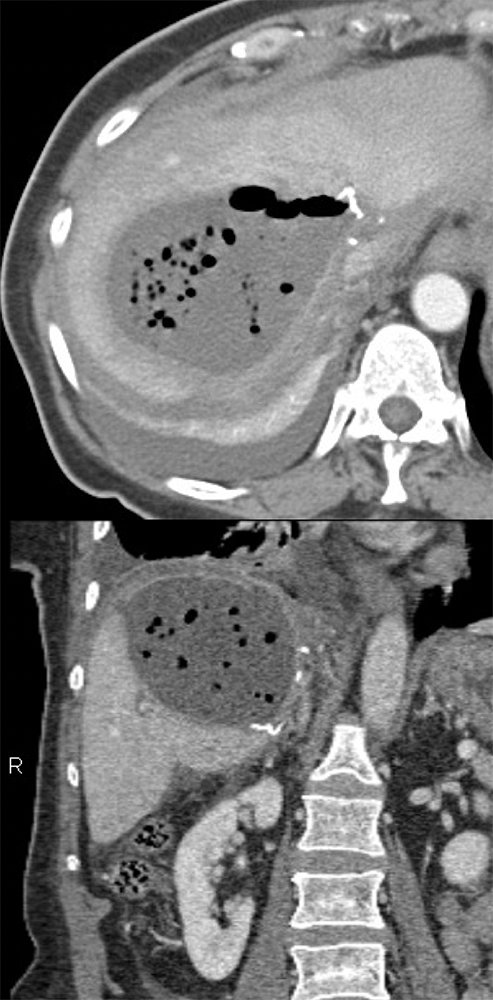 Post-Operative Liver Abscess