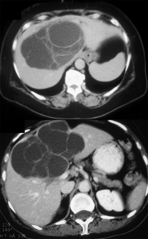 Biliary Cystadenoma