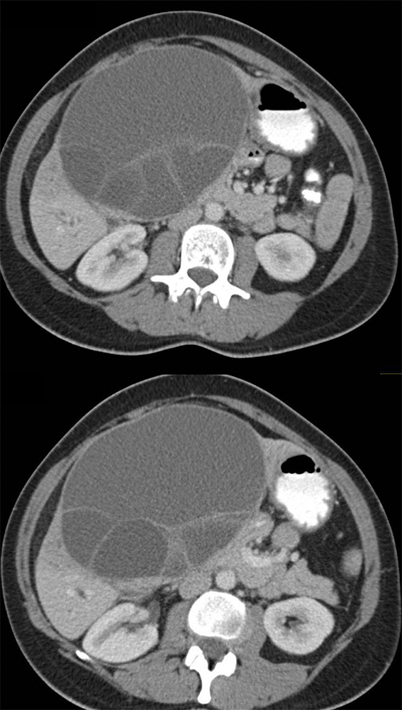 Biliary Cystadenoma