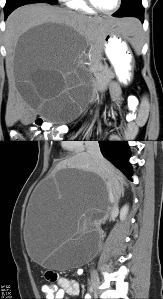 CT of Liver Masses