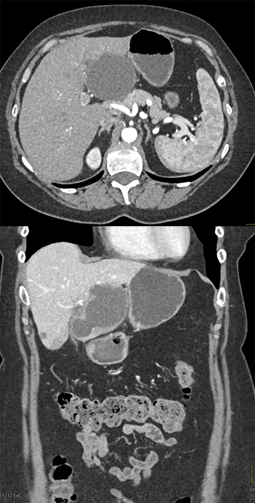 Biliary Cystadenocarcinoma