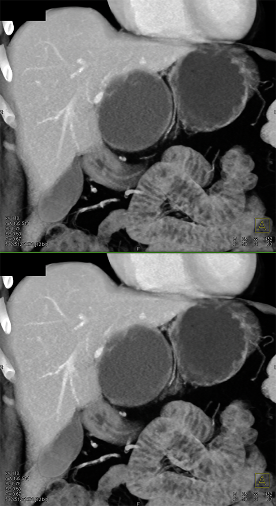 CT of Liver Masses