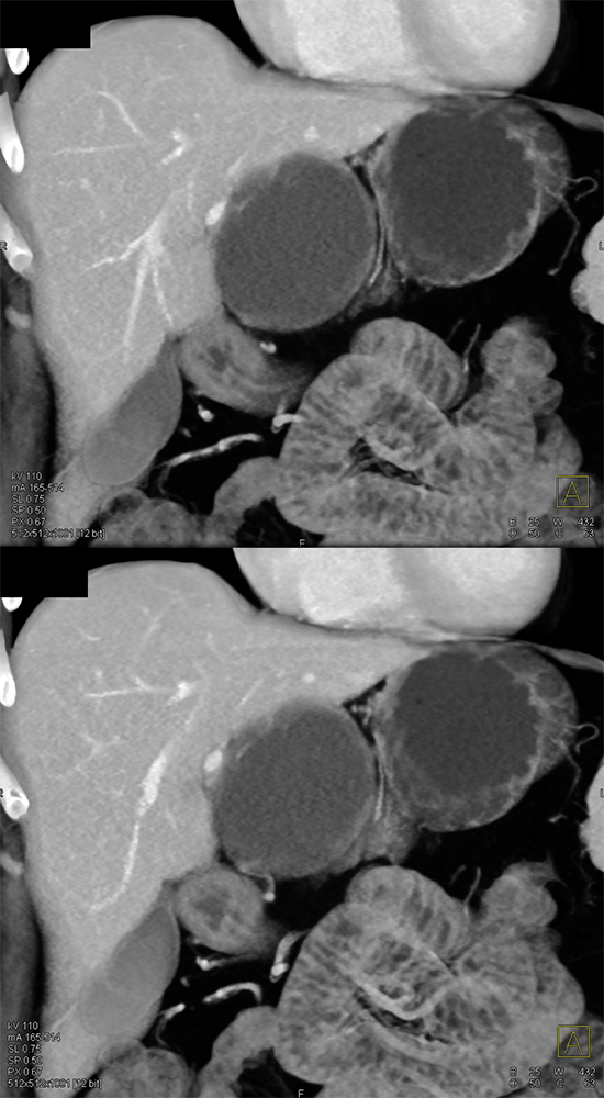 CT of Liver Masses