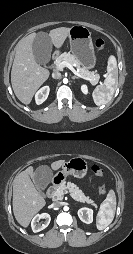 Biliary Cystadenoma with Subtle Septations