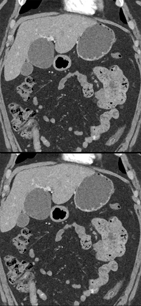 CT of Liver Masses