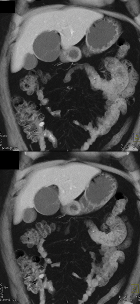 CT of Liver Masses