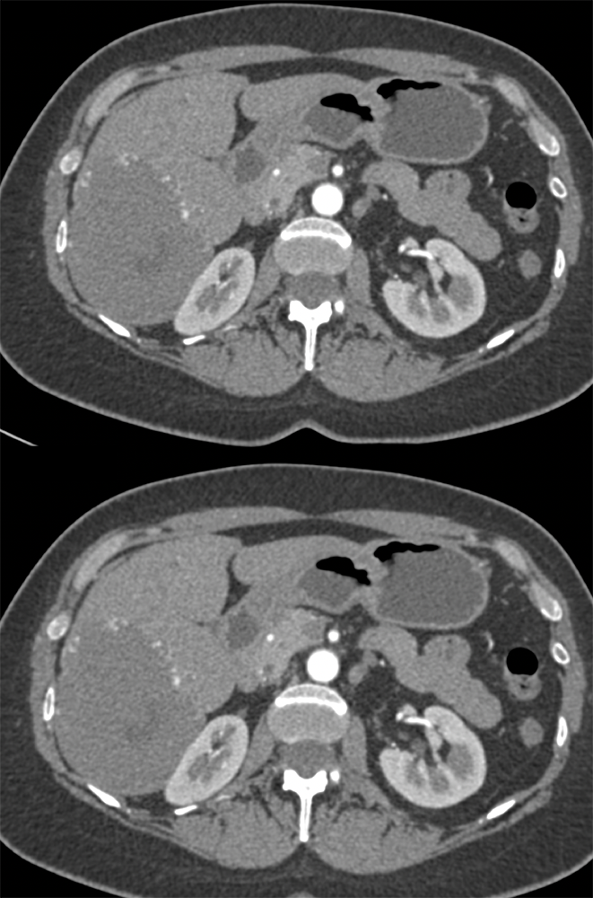 Giant Hemangioma