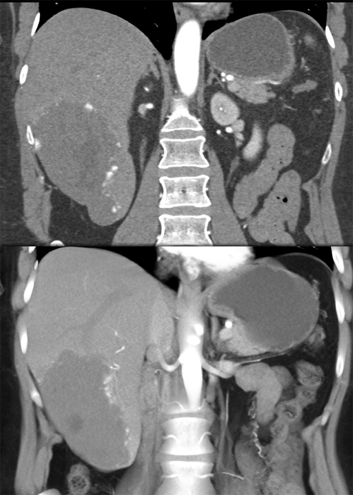 CT of Liver Masses