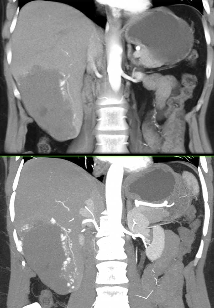 CT of Liver Masses