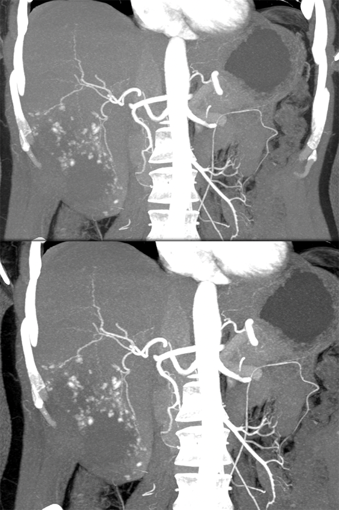 CT of Liver Masses