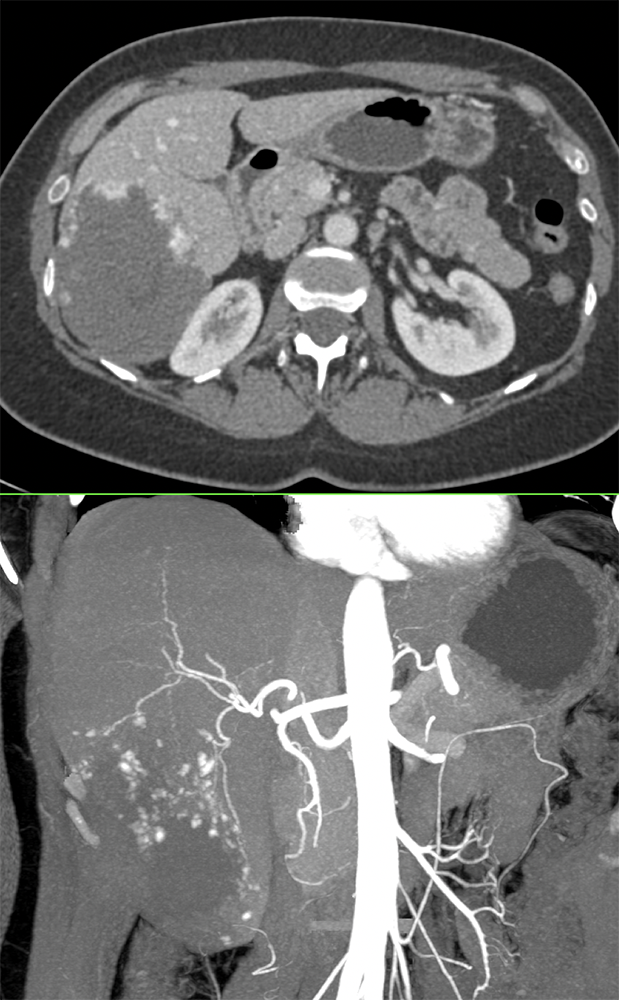 Gastrointestinal - Learning Modules - CTisus.com CT Scanning