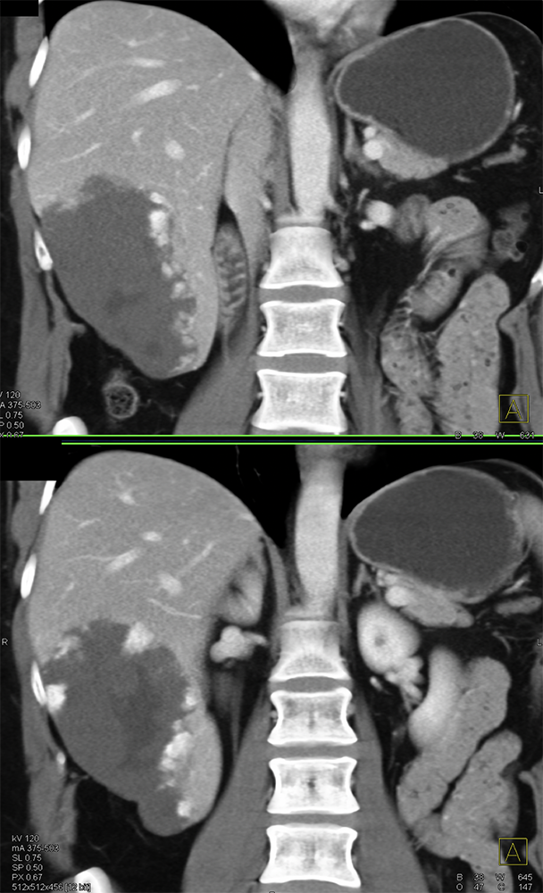 CT of Liver Masses