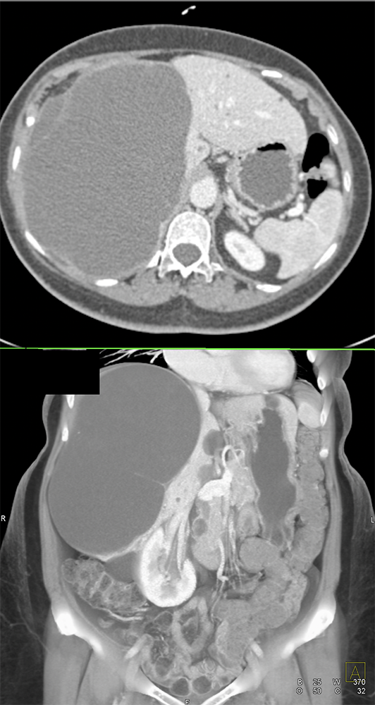 CT of Liver Masses