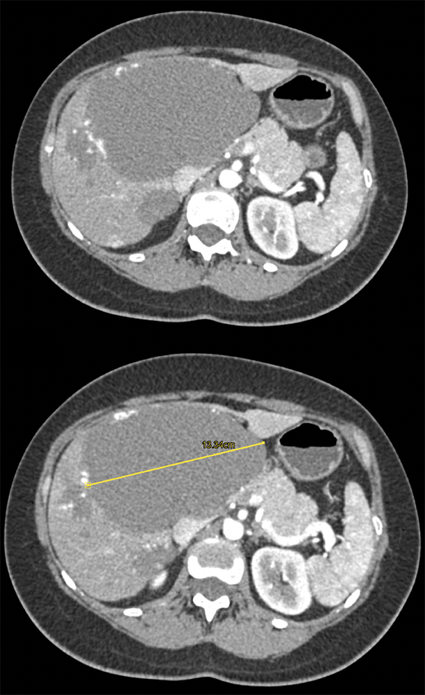 Giant Hepatic Hemangioma