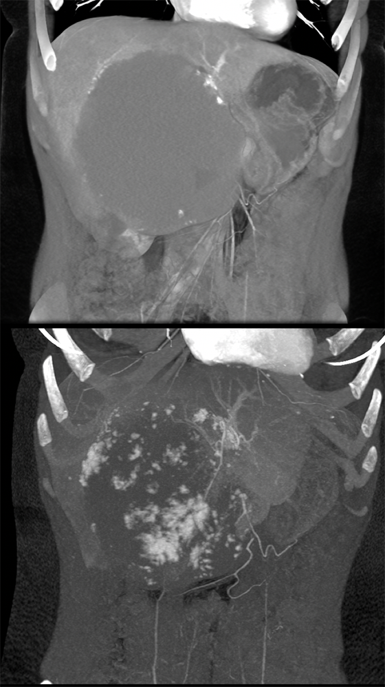 Gastrointestinal Learning Modules Ctisus Com Ct Scanning