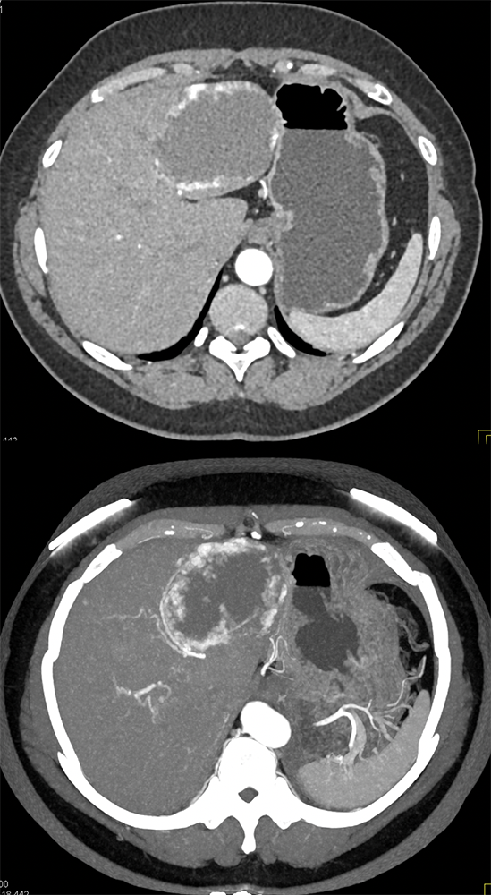 Hepatic Hemangioma