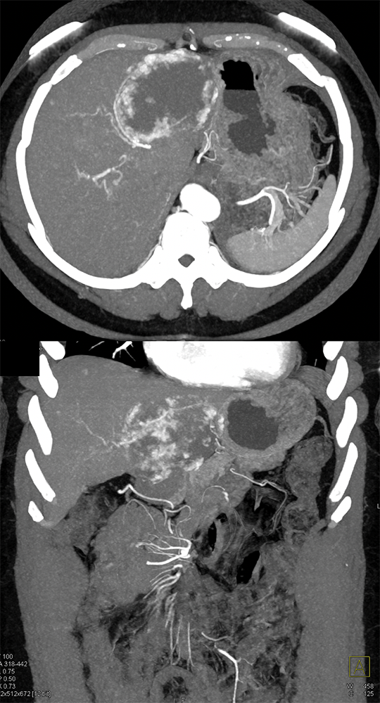 Gastrointestinal Learning Modules Ctisus Com Ct Scanning