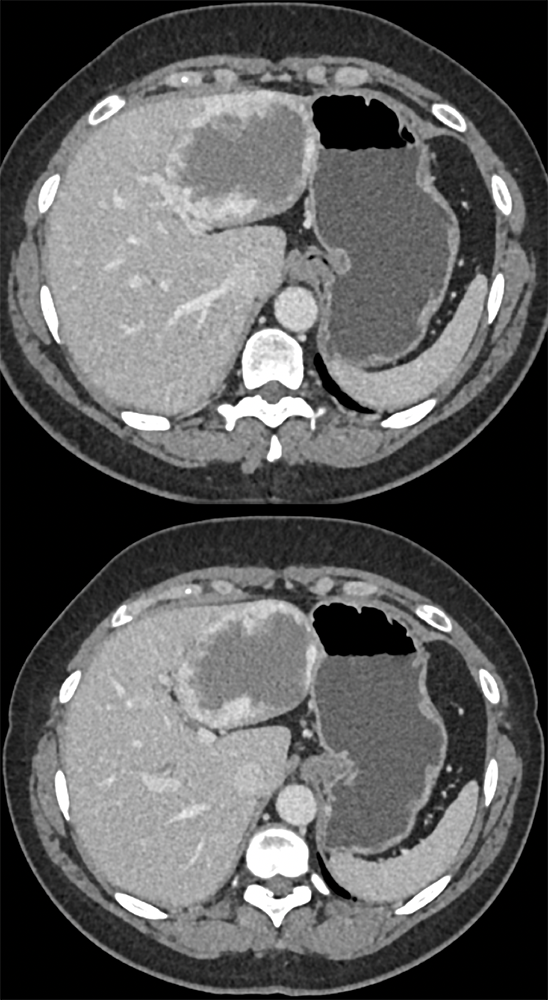 CT of Liver Masses