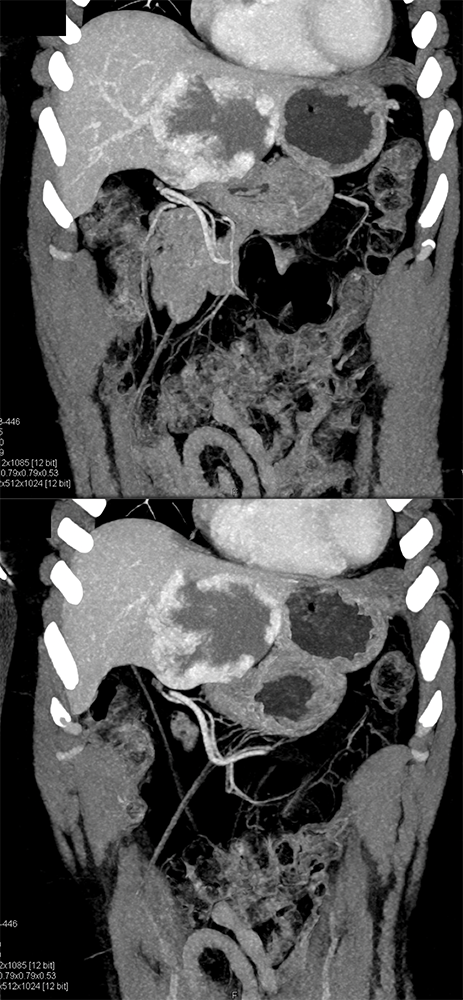 CT of Liver Masses