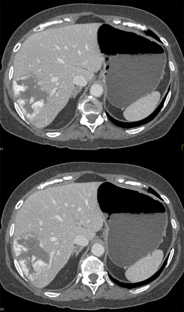 Classic Hepatic Hemangioma