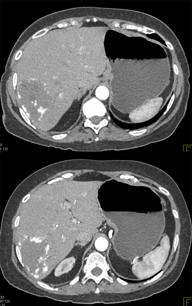 CT of Liver Masses