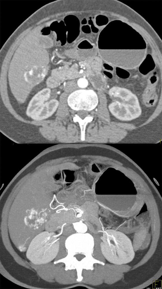 Hemangioma