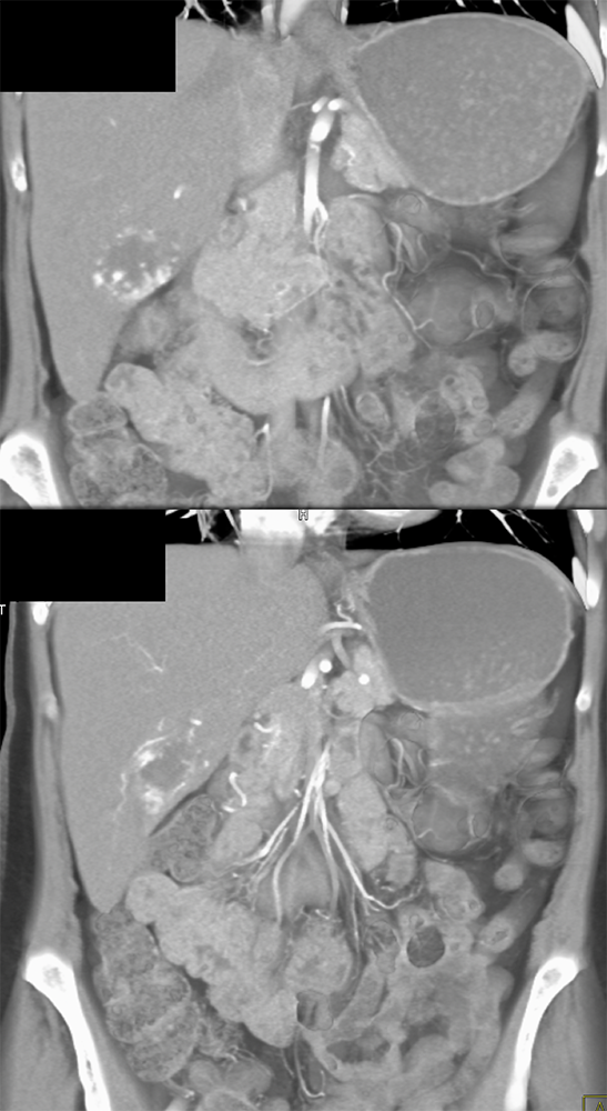 CT of Liver Masses