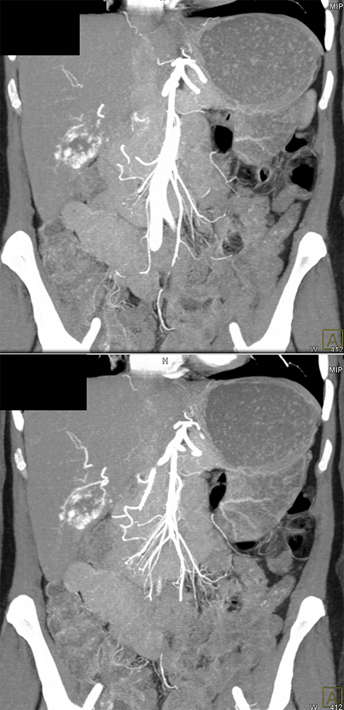 Gastrointestinal - Learning Modules - CTisus.com CT Scanning