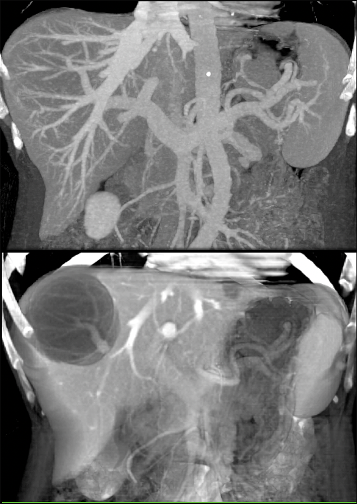 Hepatic Cyst