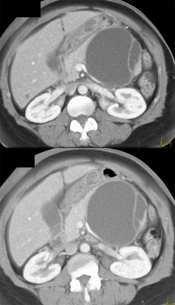 Abdominal Discomfort