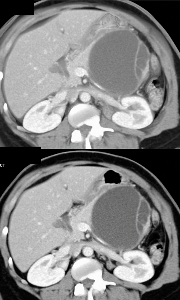 Mucinous Cystic Neoplasm