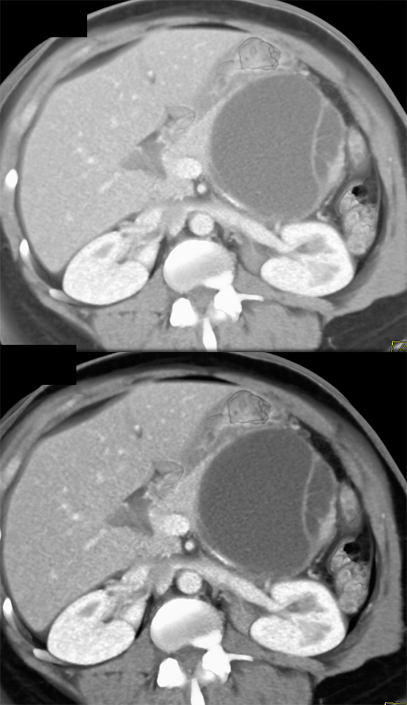 Mucinous Cystic Neoplasm