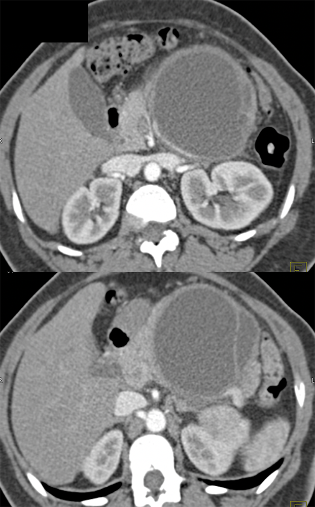 Mucinous Cystic Neoplasm