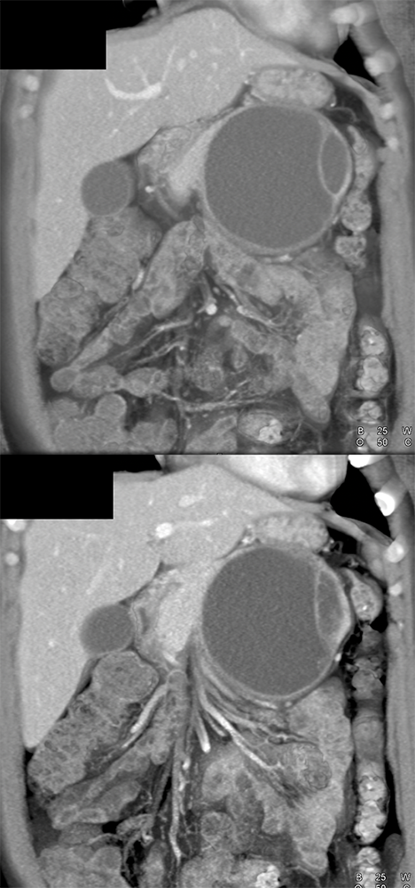 Mucinous Cystic Neoplasm