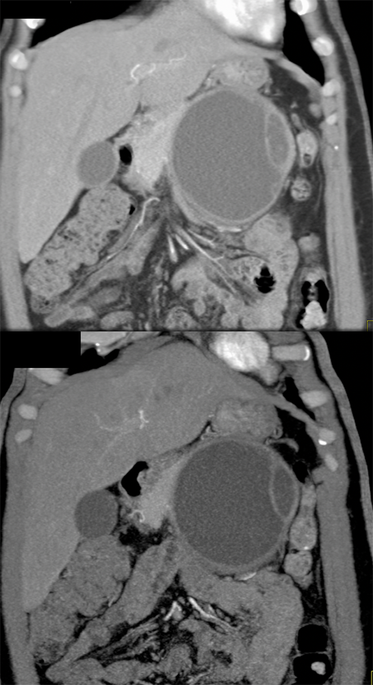 Mucinous Cystic Neoplasm