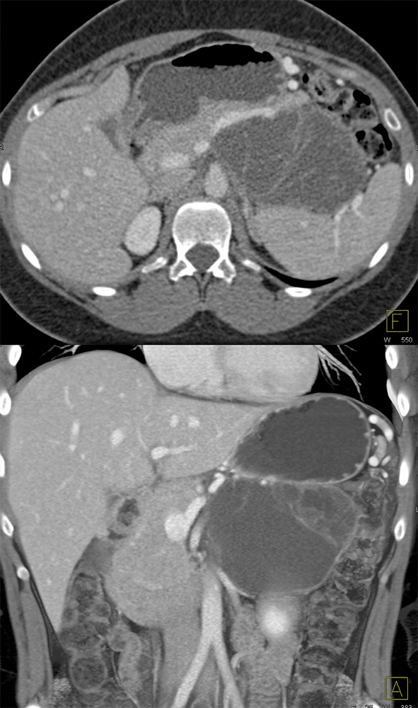 Mucinous Cystic Neoplasm