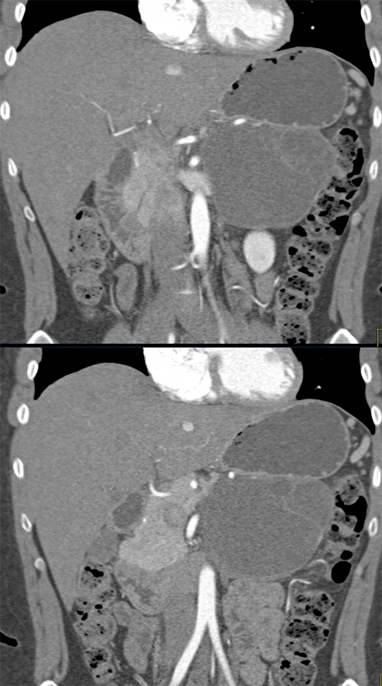 Mucinous Cystic Neoplasm