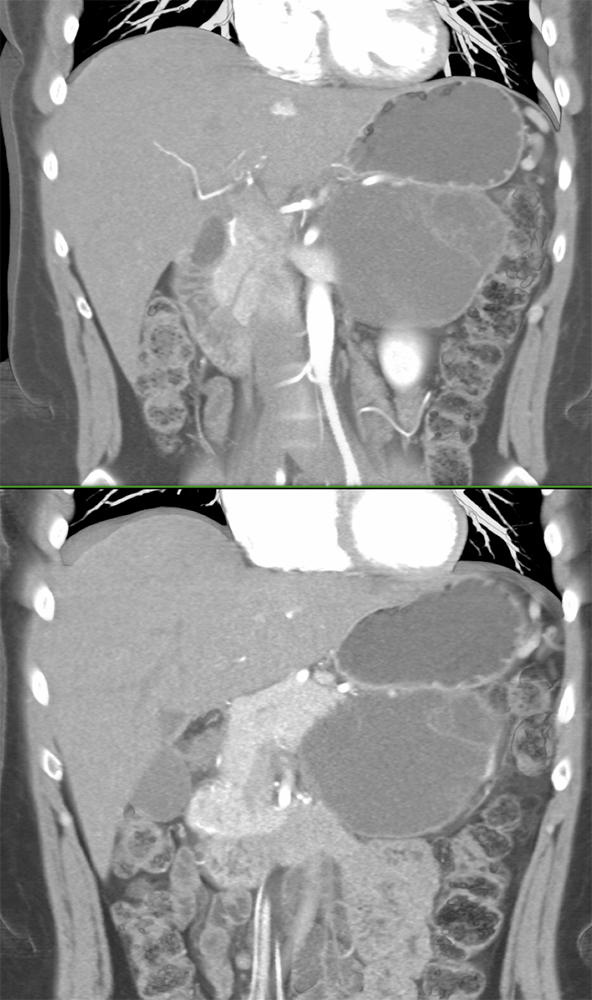 Mucinous Cystic Neoplasm