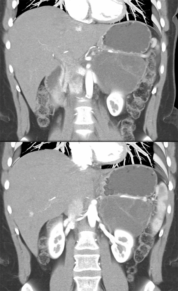 Mucinous Cystic Neoplasm