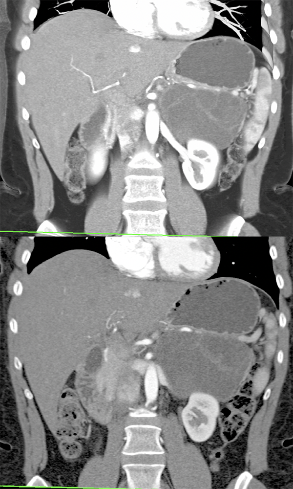 Mucinous Cystic Neoplasm