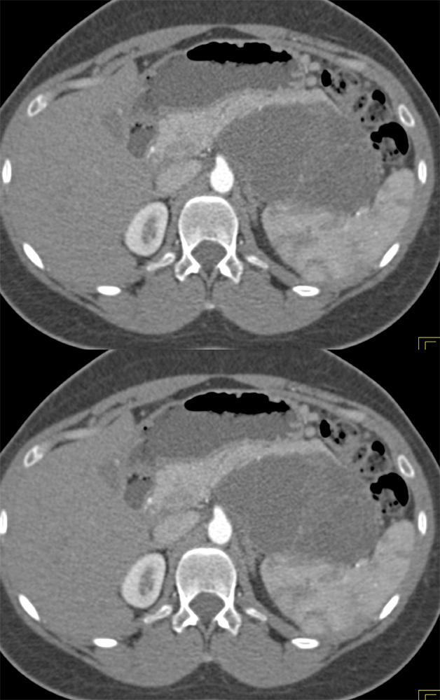 MCN with High Grade Dysplasia