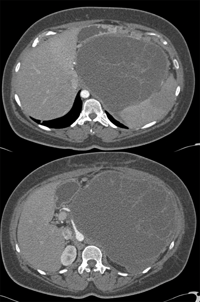 Invasive Carcinoma in a Mucinous Cystic Neoplasm of the Pancreas