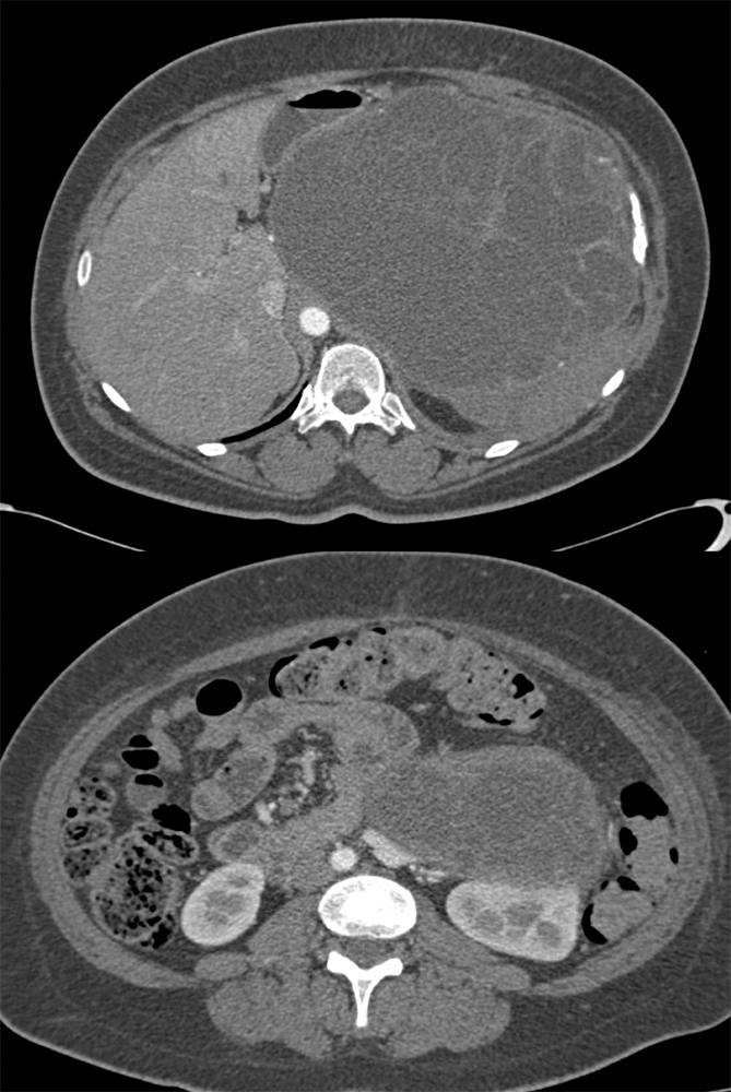 Mucinous Cystic Neoplasm