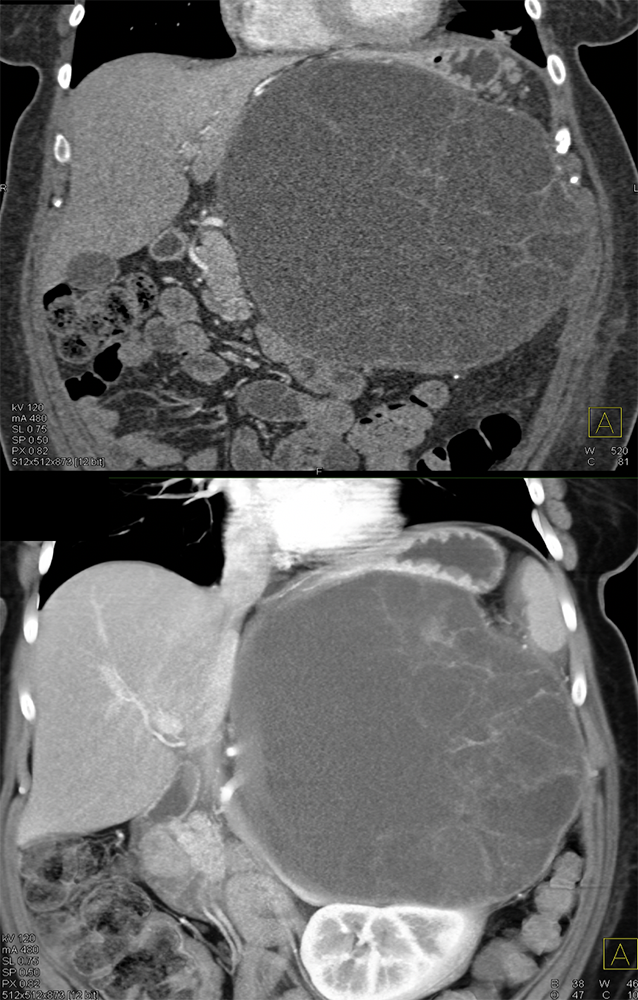 Mucinous Cystic Neoplasm