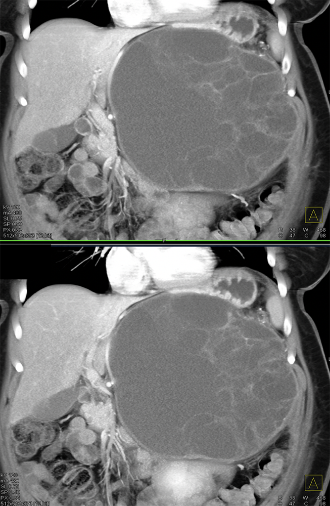 Mucinous Cystic Neoplasm