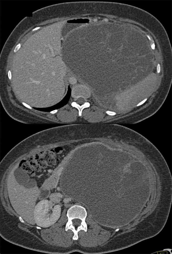 Mucinous Cystic Neoplasm