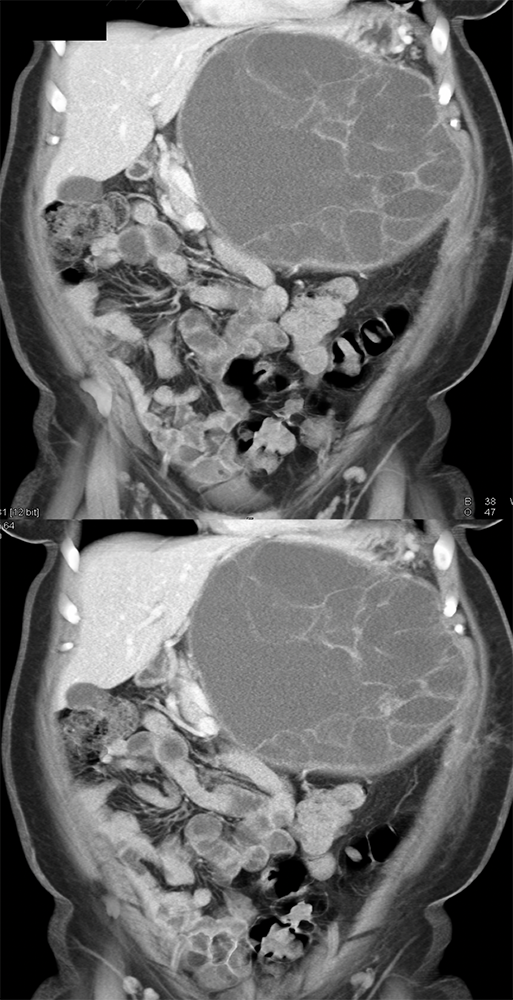 Mucinous Cystic Neoplasm