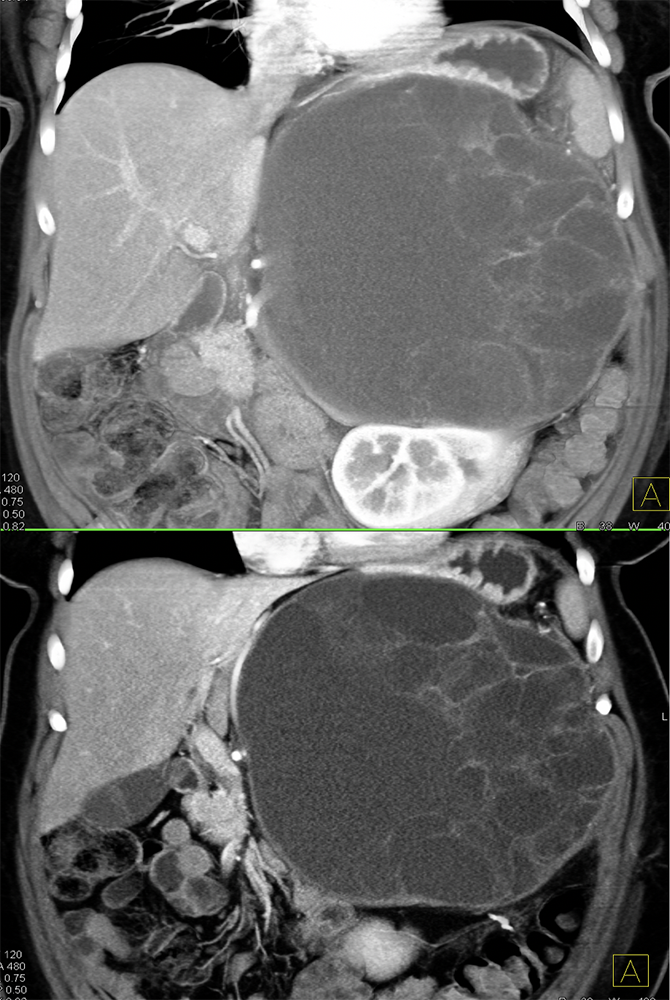 Mucinous Cystic Neoplasm