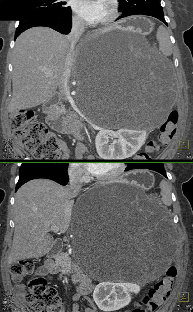 Mucinous Cystic Neoplasm